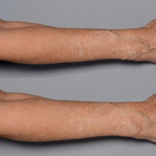 Антивозрастной крем для тела Perricone MD Cold Plasma Plus Fragile Skin Therapy, 177 мл